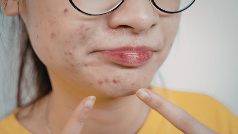 Acne breakouts solution