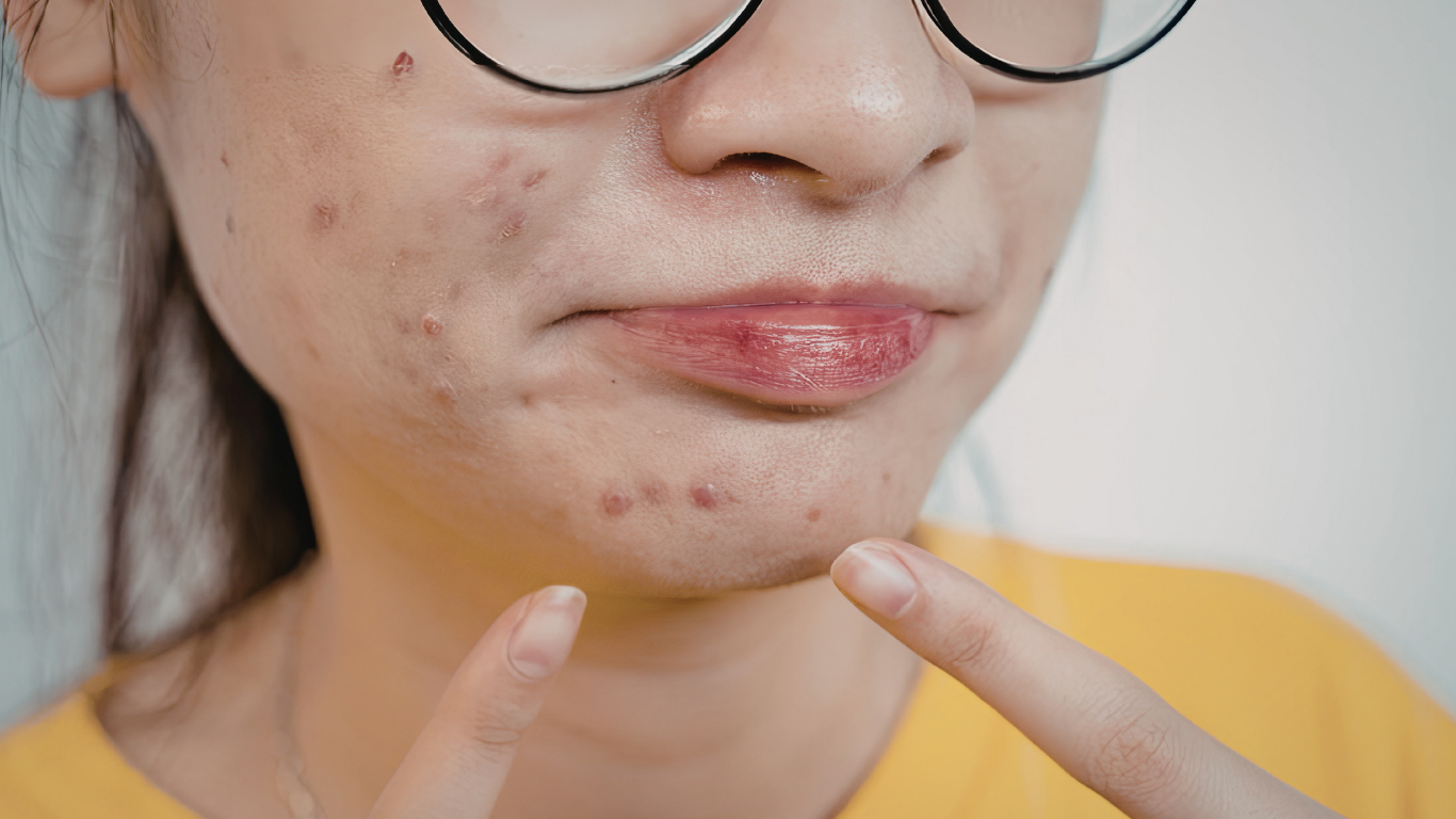 Acne breakouts solution